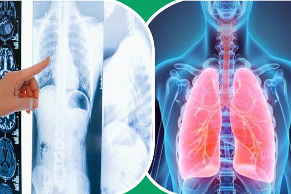 শীতে ফুসফুসের সংক্রমণ এড়াতে যা করবেন