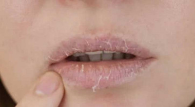 এই গরমেও ফাটছে ঠোঁট?