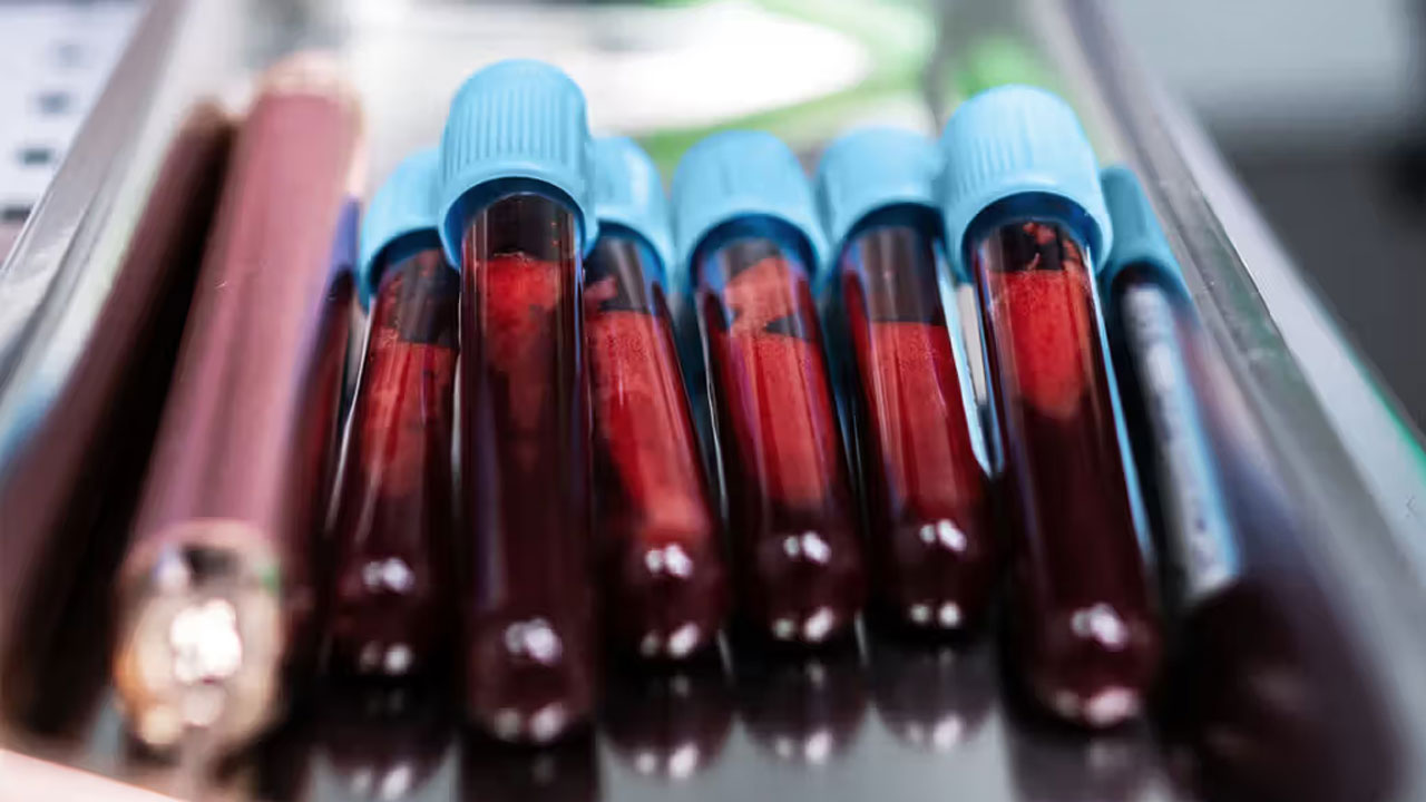 ছড়িয়ে পড়া স্তন ক্যানসার চিকিৎসায় &lsquo;গেম-চেঞ্জার&rsquo; হতে পারে নতুন এক পরীক্ষা