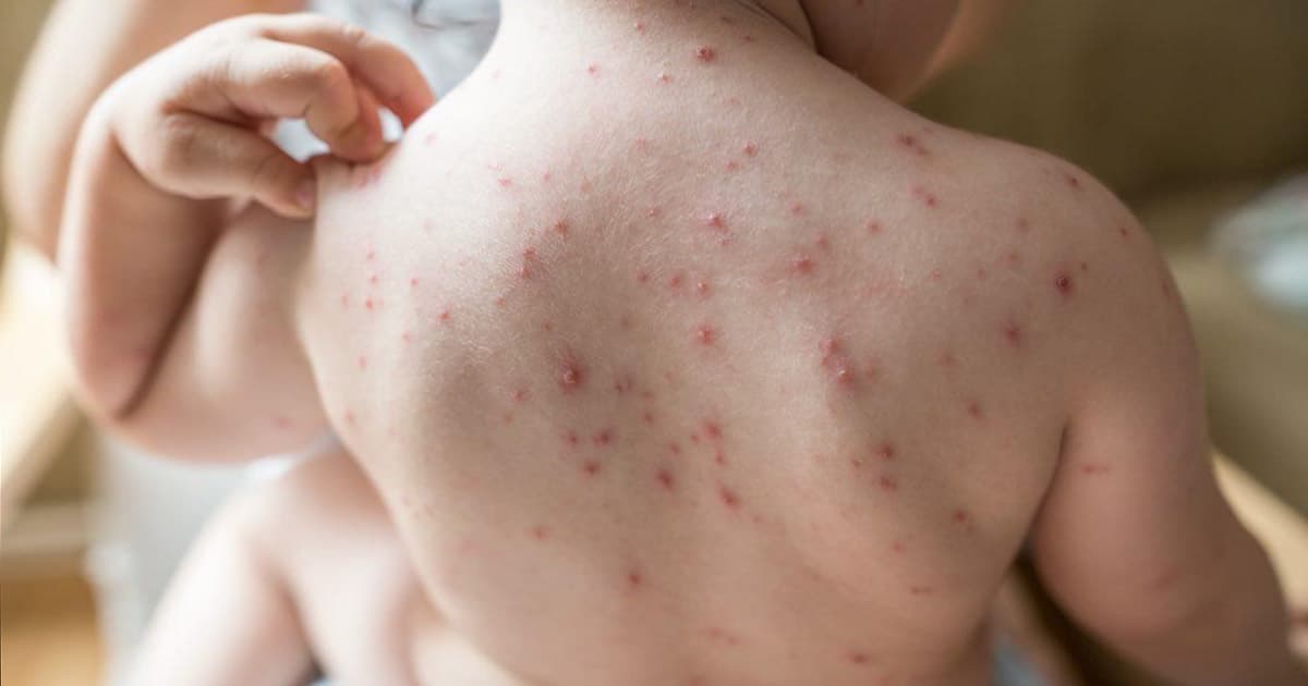 সিলেটে হামের উপসর্গে আরও এক শিশুর মৃত্যু, প্রাণহানি বেড়ে ৬