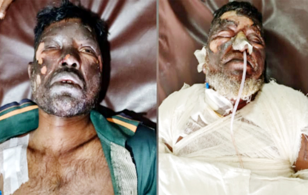  দগ্ধ ২ জনের অবস্থা আশঙ্কাজনক, ঢাকায় প্রেরণ