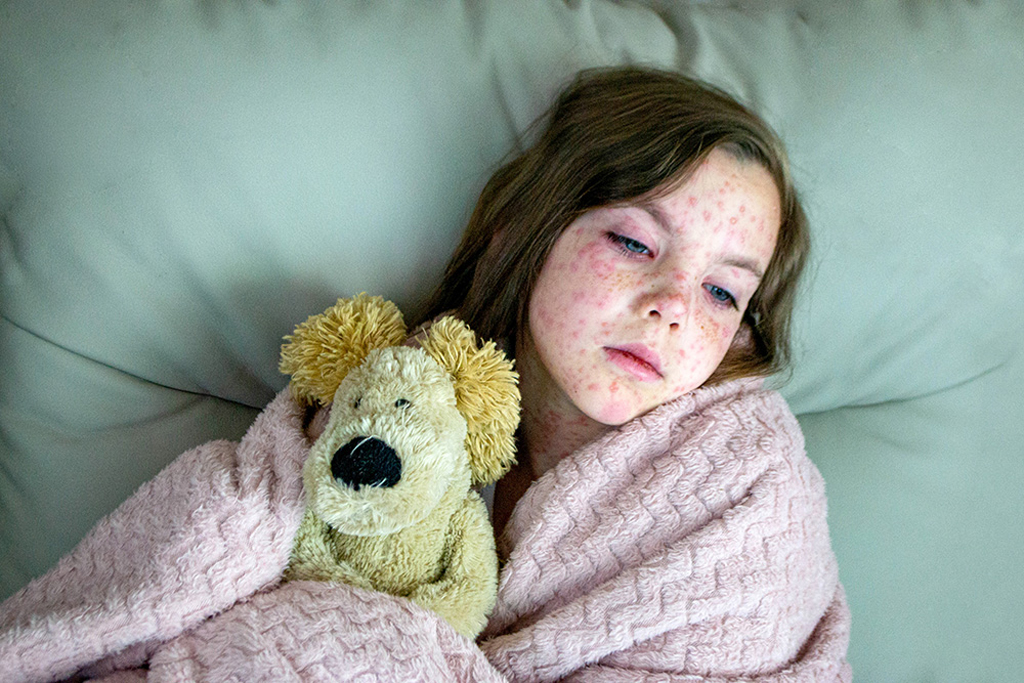 হামের সংক্রমণ ঠেকাতে যে পরামর্শ বিশেষজ্ঞদের