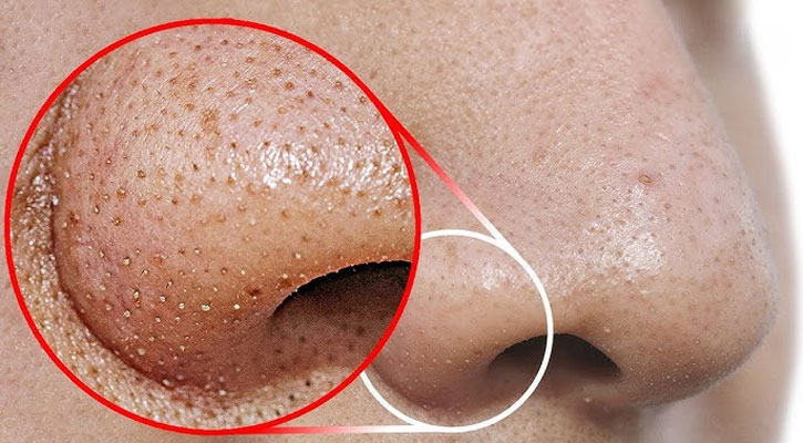 নাকের ডগায় ব্ল্যাকহেডস?