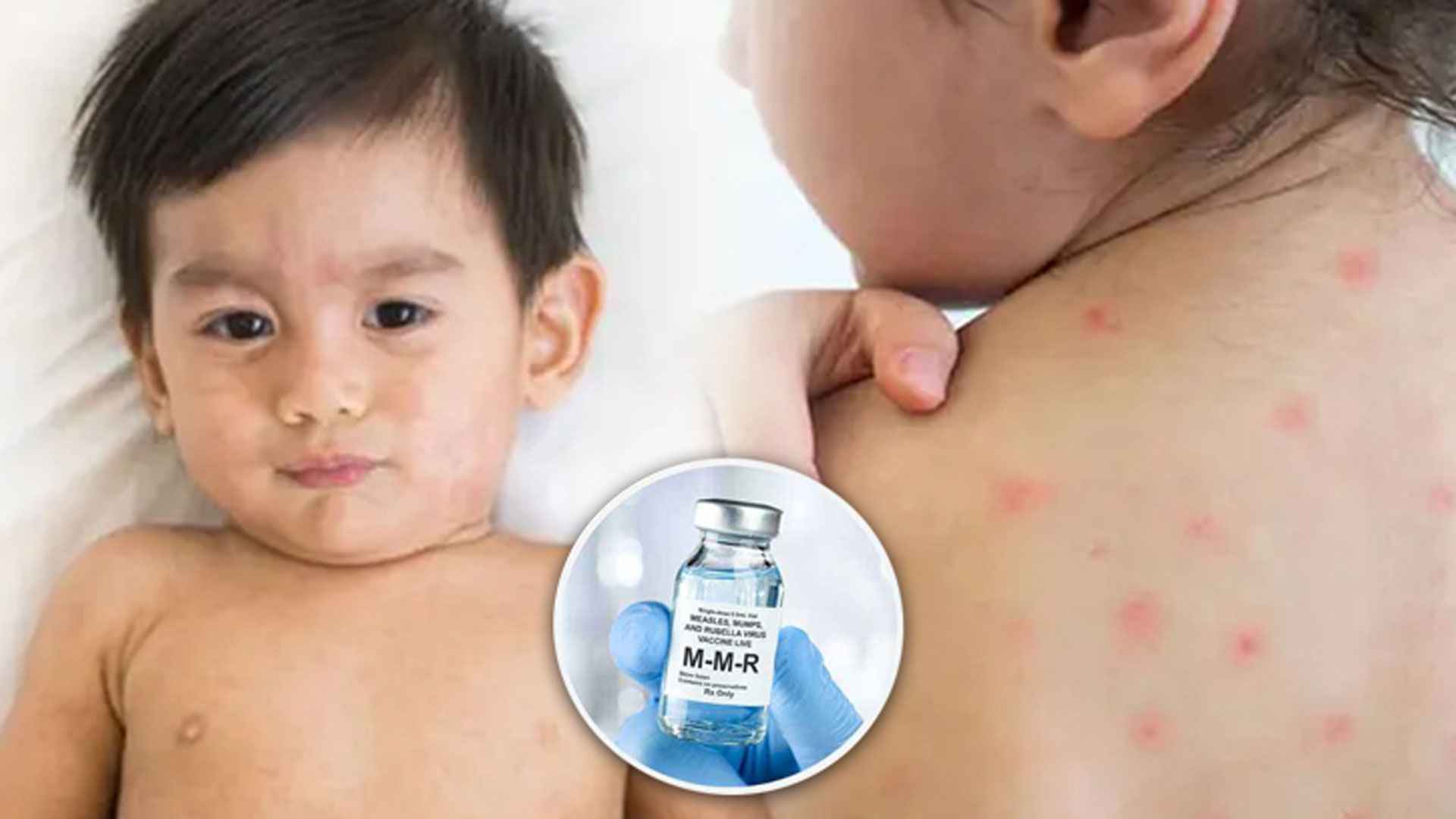 বাংলাদেশ ছাড়াও যেসব দেশের মানুষ হামে আক্রান্ত হচ্ছে