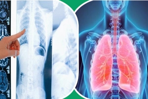 শীতে ফুসফুসের সংক্রমণ এড়াতে যা করবেন