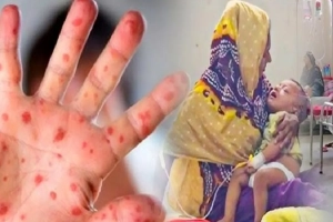 সিলেটে হামে আরও এক শিশুর মৃত্যু