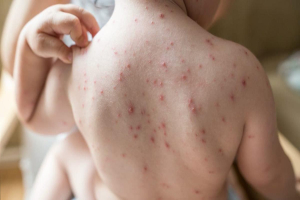 সিলেটে হামের উপসর্গে আরও এক শিশুর মৃত্যু, প্রাণহানি বেড়ে ৬