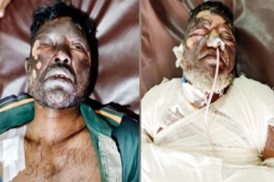  দগ্ধ ২ জনের অবস্থা আশঙ্কাজনক, ঢাকায় প্রেরণ