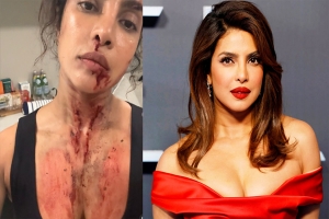 প্রিয়াঙ্কার নাক-গলায় রক্তের দাগ!