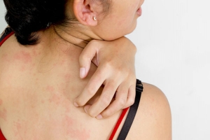 গরমে অস্বস্তিকর ঘামাচি!