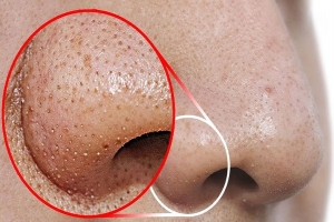 নাকের ডগায় ব্ল্যাকহেডস?