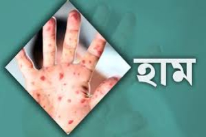 সিলেটে হাম উপসর্গে ২৪ ঘণ্টায় আরও ২ শিশুর মৃত্যু